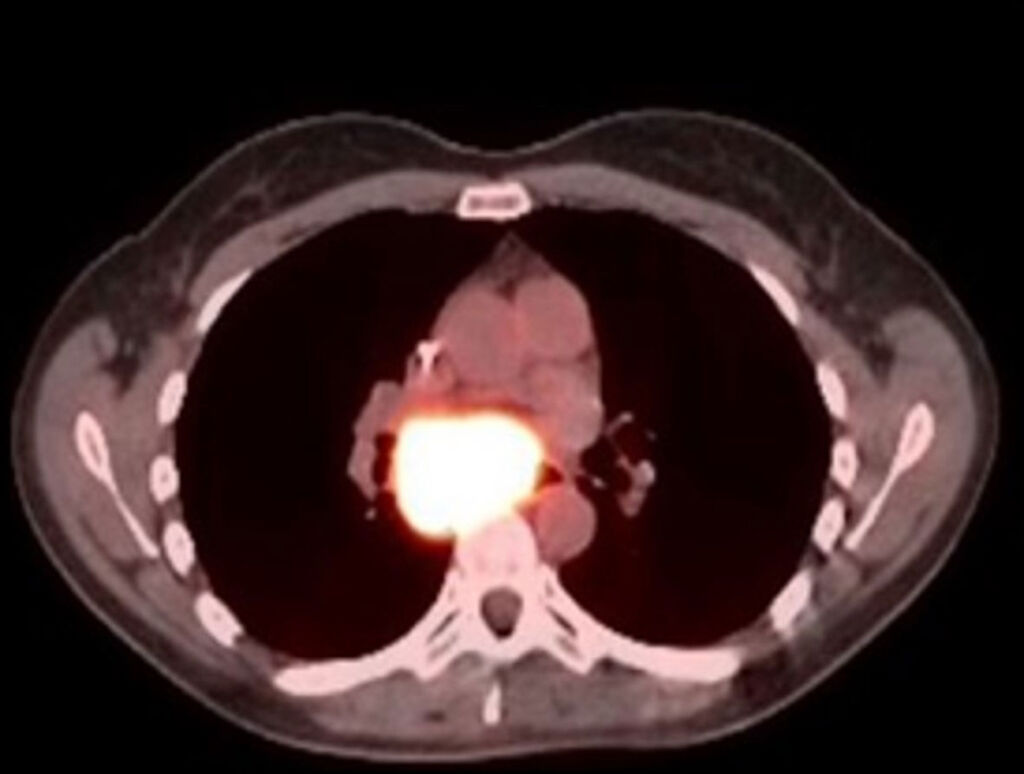 PET/CT after 18 months on BXQ-350