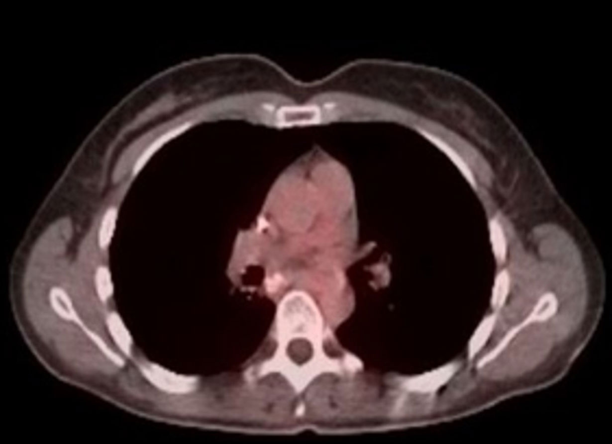 PET/CT after 18 months on BXQ-350